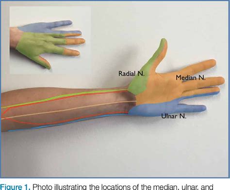 Figure 1 From Ultrasound Guided Ulnar Median And Radial Nerve Blocks