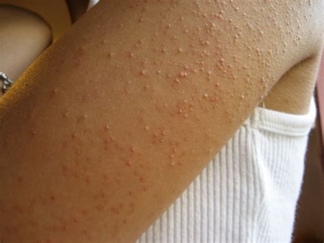 What Causes Keratosis Pilaris Dorothee Padraig South West Skin Health