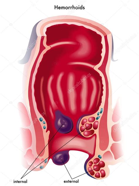 Hemorrhoids may be external or internal. Inre och yttre hemorrojder. — Stock Vektor © rob3000 #65091413