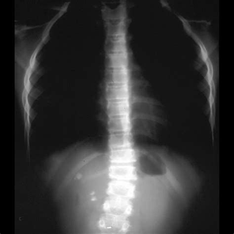 Post Radiation Scoliosis Pediatric Radiology Reference Article