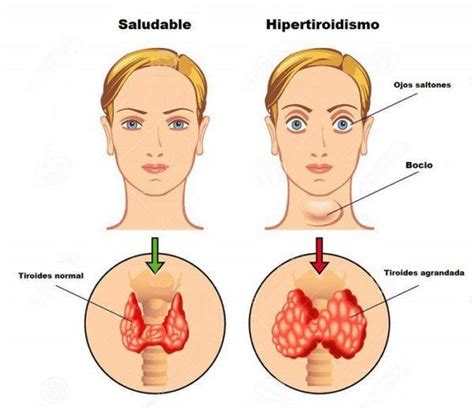 S Ntomas Del Hipertiroidismo Qu Es Causas Y Tratamiento Demedicina