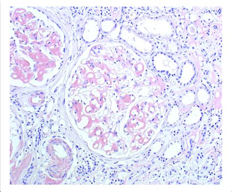 Patient Ii Renal Biopsy Congo Red Staining Showing Amyloid