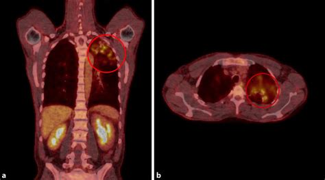 Pet Ct Scan Images Of Coronal A And Axial B Planes Showing High