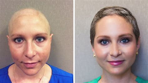 National Hair Loss Chemotherapy Hair Loss And Regrowth Youtube