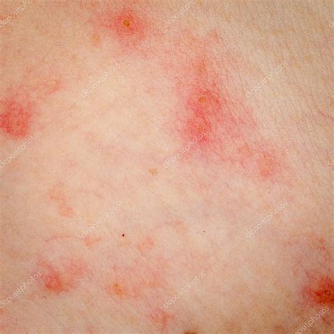 Erupción Alérgica Dermatitis Eccema Piel 2023