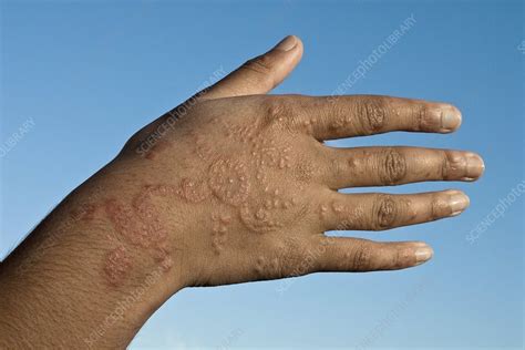 Allergic Reaction Stock Image C0027660 Science Photo Library
