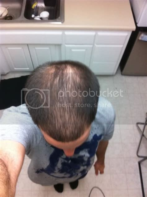 Gallery For Balding Crown Buzz Cut