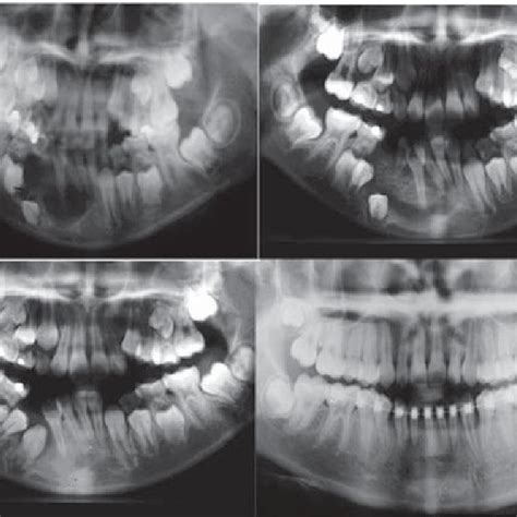 Pdf Surgical Management Of Dentigerous Cyst And Keratocystic