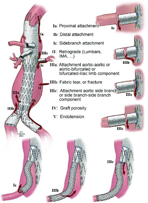 Classification Of Endoleaks Of Fenestrated Branched Endovascular Aortic