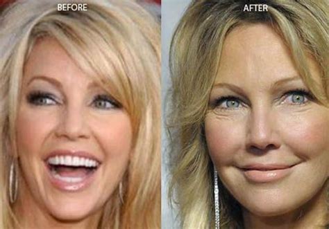 Pin On Celebrity Before After