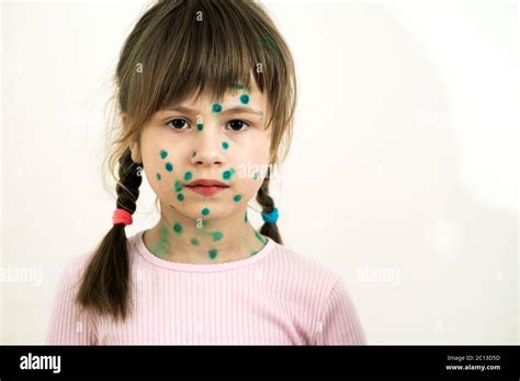 Child Girl Covered With Green Rashes On Face Ill With Chickenpox