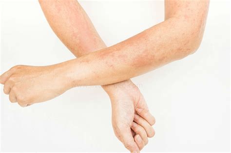 10 Most Common Types Of Skin Rashes Daily Health Valley Kulturaupice