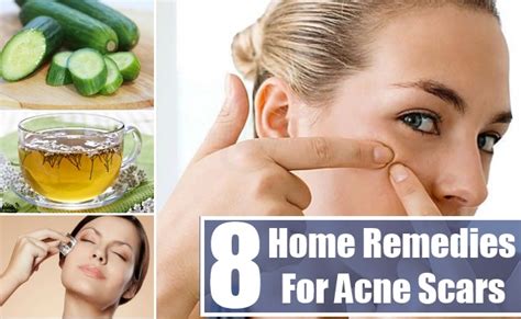8 Best Home Remedies For Acne Scars Natural Home