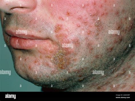 Impetigo Close Up Of Crusty Yellow Sores On The Face Of A Man Caused