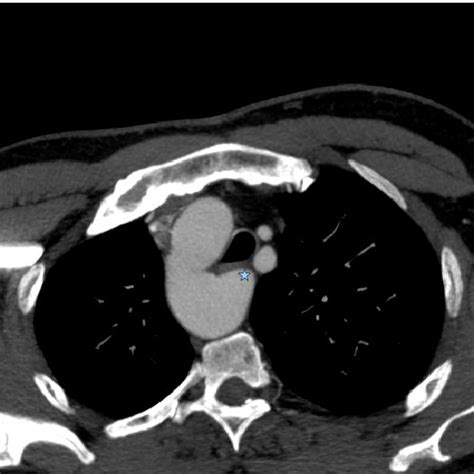 Axial Contrast Ct At The Level Of Aortic Arch Shows Right Sided Aortic