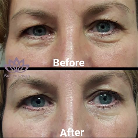 Calgary Laser Eye Tightening Revive Laser And Skin Clinic