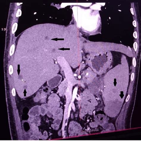 Ct Abdomen Image Showing Multiple Liver Abscesses Splenic Abscesses