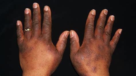 Eczema Dark Spots And Discoloration Treatment Types And More