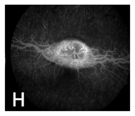 Color Fundus Photographs Fundus Fluorescein Angiography And Optical