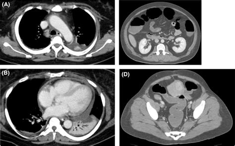 Computed Tomography Ct Scan Images A An Enlarged Mediastinal Lymph