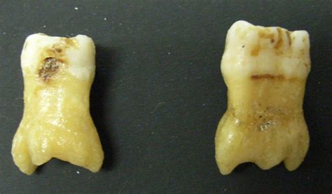 How to strengthen teeth roots. What is Taurodontism? | News | Dentagama