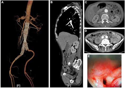 Frontiers Case Report Remedial Surgical Treatment Of Aorto Duodenal