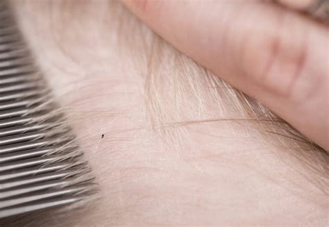 Head Lice Here Are 14 Tips And Facts From Lice Experts The Healthy