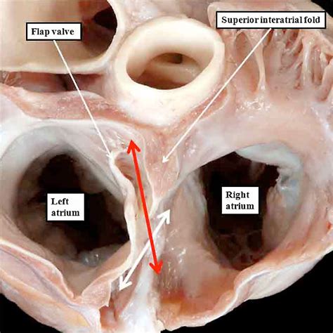 Cardiovascular System Atrial Septal Defects Embryology