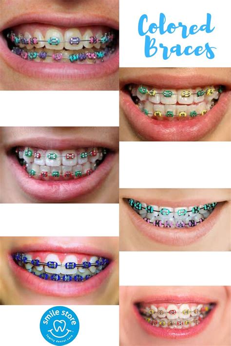 How To Get White Spots Off Teeth With Braces The Guide Ways