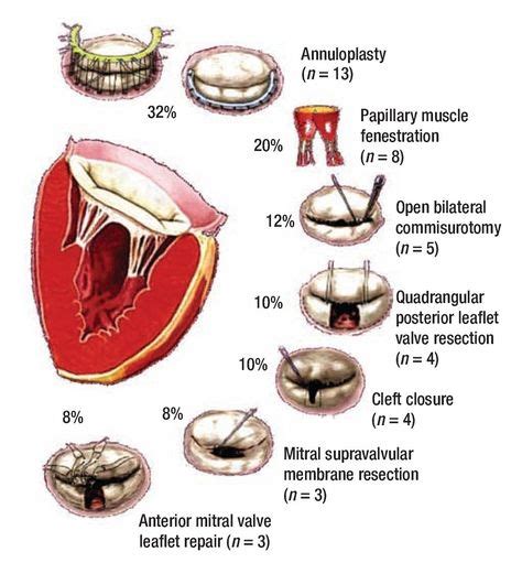 Pin By Melissa Blaker On Cardiac Surgery Mitral Valve Cardiology