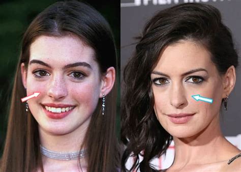 Anne Hathaway Plastic Surgery Revealed Before And After 2021