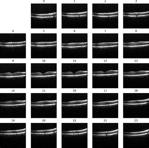 identification of sex and age from macular optical coherence tomography and feature analysis