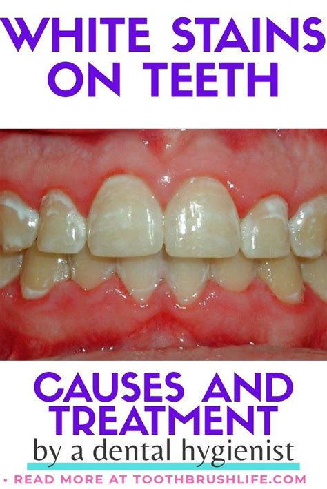 We did not find results for: White Spots On Teeth - Causes & How to Get Rid of Them ...