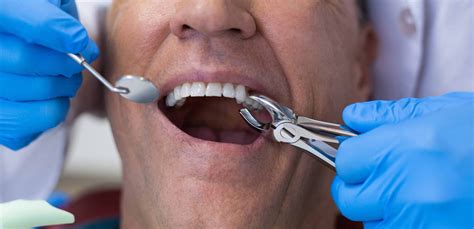 Dental extractions the most common reason for compensation - Dentistry ...