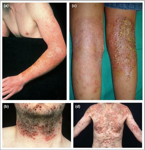 The Role Of Bacterial Skin Infections In Atopic Dermatitis Expert