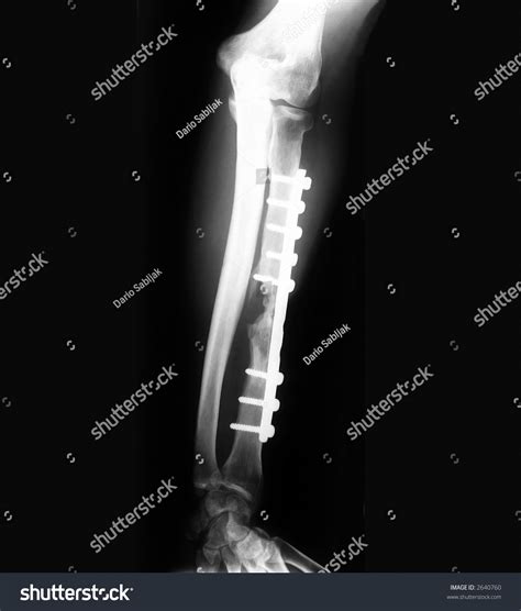 Broken Forearm With Implant On X Ray Film Stock Photo 2640760