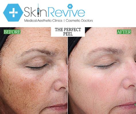 The Perfect Peel Is A Revolutionary Chemical Peel That Will Transform