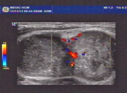Vietnamese Medic Ultrasound Case Left Supraclavicular Mass Dr