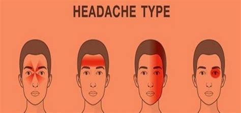 Pin On Headache Type