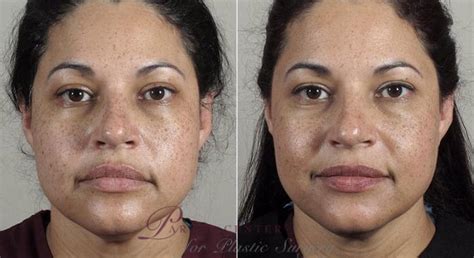 Nonsurgical Face Procedures Before And After Pictures Case 309
