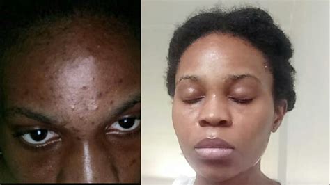 How I Cleared My Acne And Dark Spots In One Week Acneproneskin