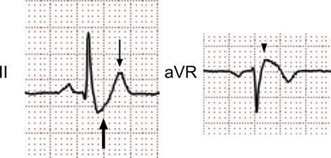Is The Diagnosis St Segment Elevation Or Nonst Segment Elevation