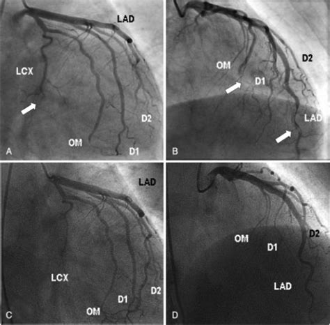 Coronary Angiography Finding A And B After Administra Open I