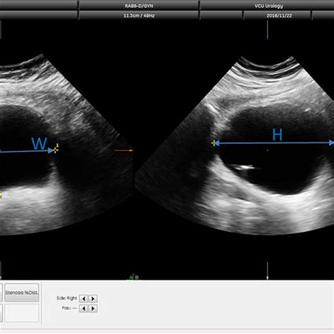 Two Examples Of Bladder Volume Measurements Throughout Filling Download Scientific Diagram