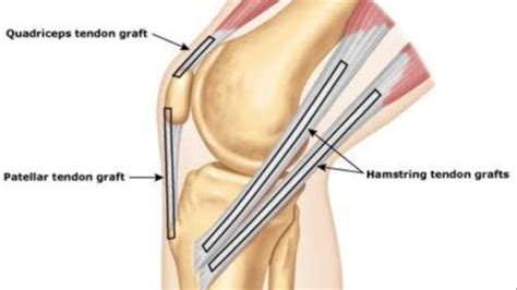 Which Graft Should I Choose For My Acl Reconstruction
