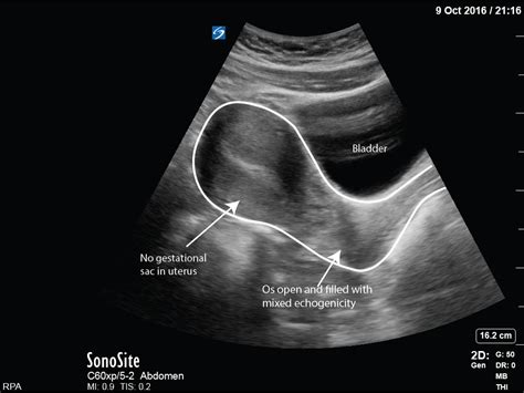 Missed Miscarriage 13 Weeks Critical Care Sonography