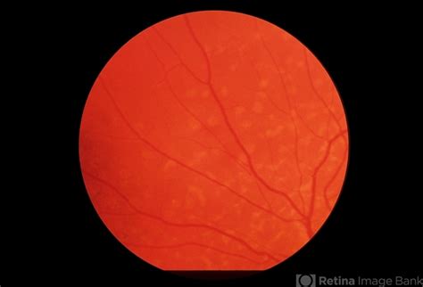 Fundus Flavimaculata Stargardts Disease Retina Image Bank