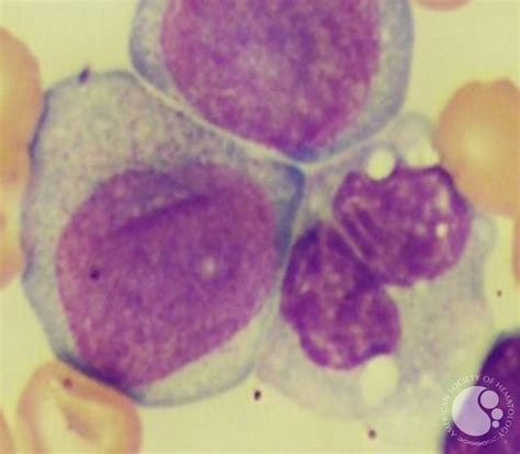 Acute Monocytic Leukemia 2