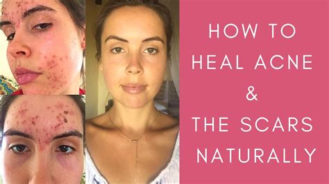 How To Heal Acne And Scars Naturally Is Accutane A Solution For Hormonal Acne Youtube