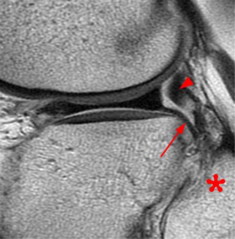 Hypermobile Lateral Meniscus Radsource